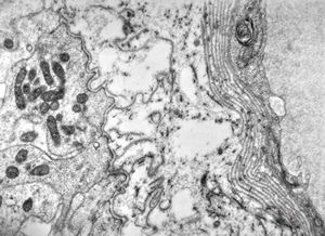 F,7y. | ependymoma- multilayered endothelial basement membrane